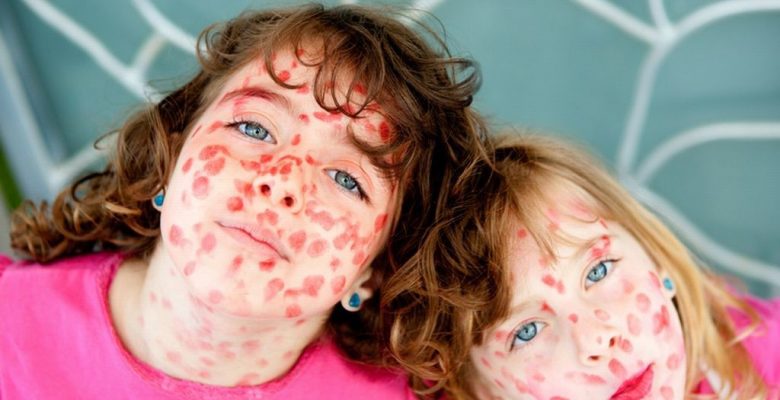 СПАЛАХ КОРУ В УКРАЇНІ: ЩО ТРЕБА ЗНАТИ ПРО ХВОРОБУ І ЯК ЗАХИСТИТИ СЕБЕ